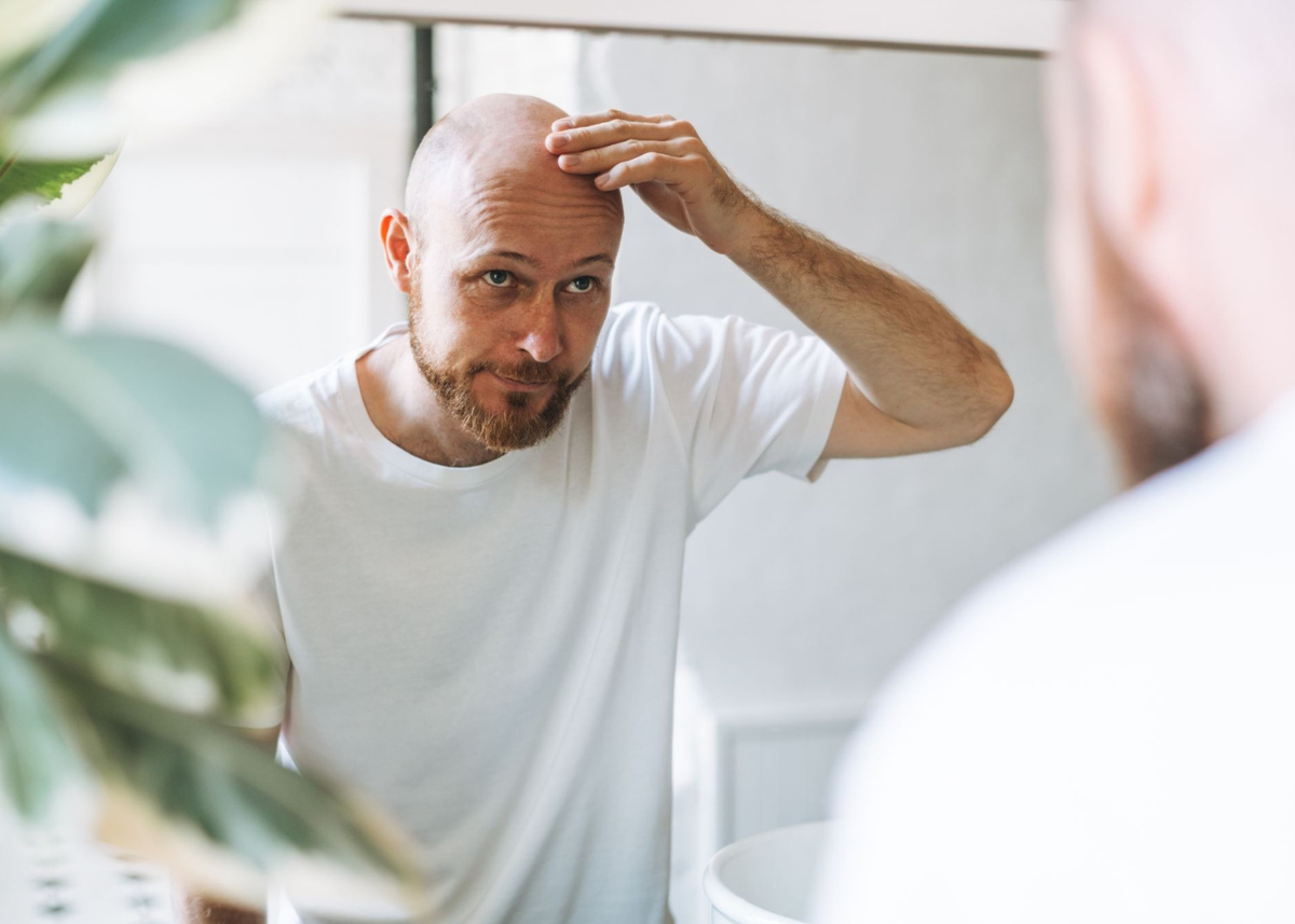 Male Hair Loss