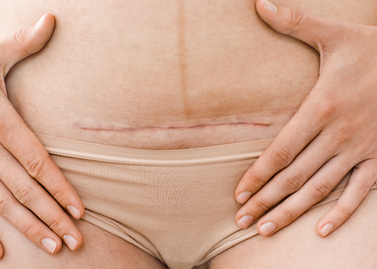 Hair loss after hysterectomy