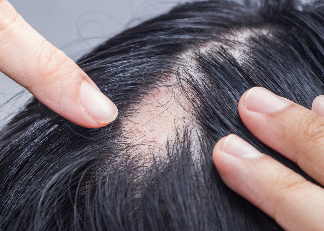 Alopecia Areata