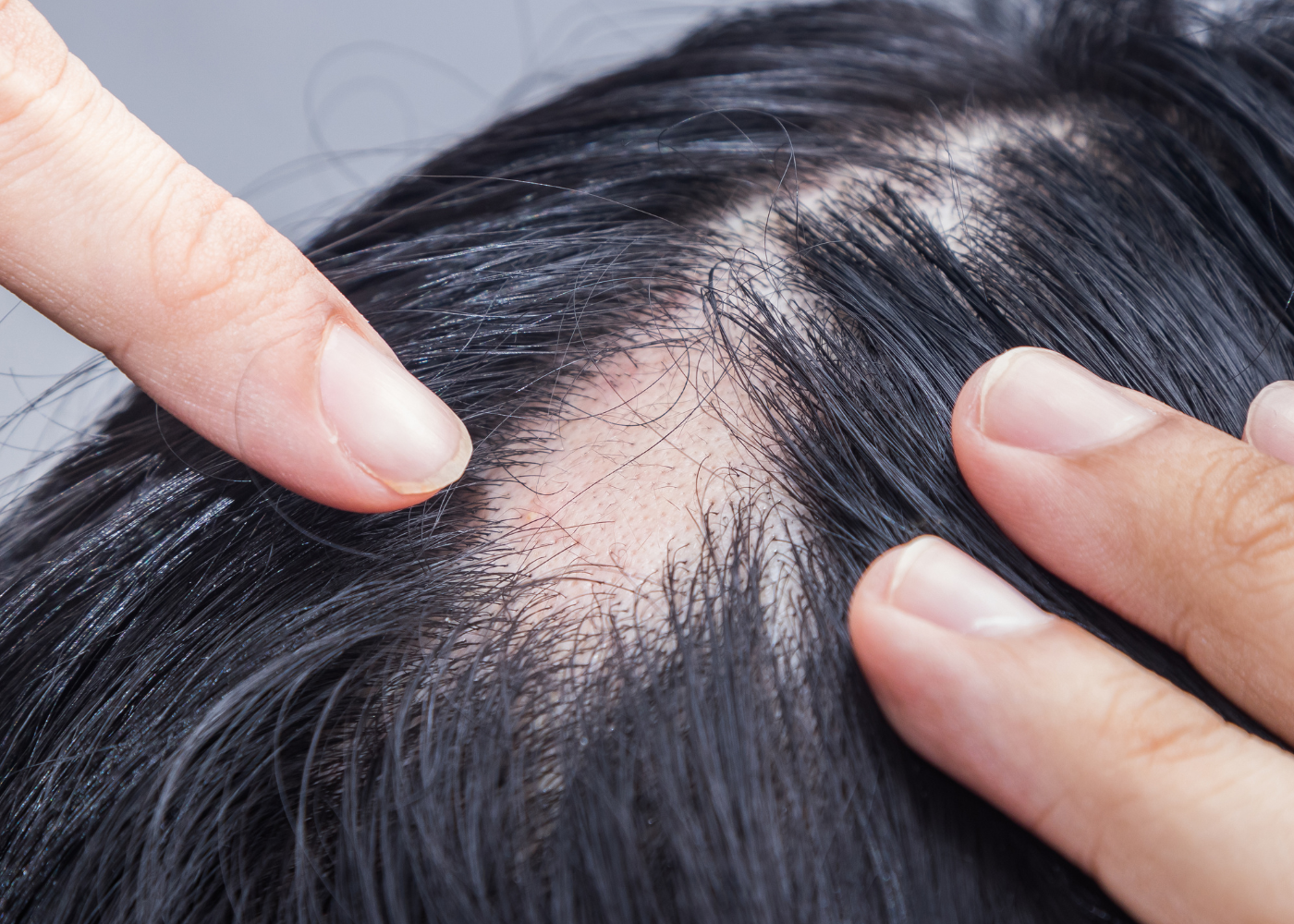 Alopecia Areata