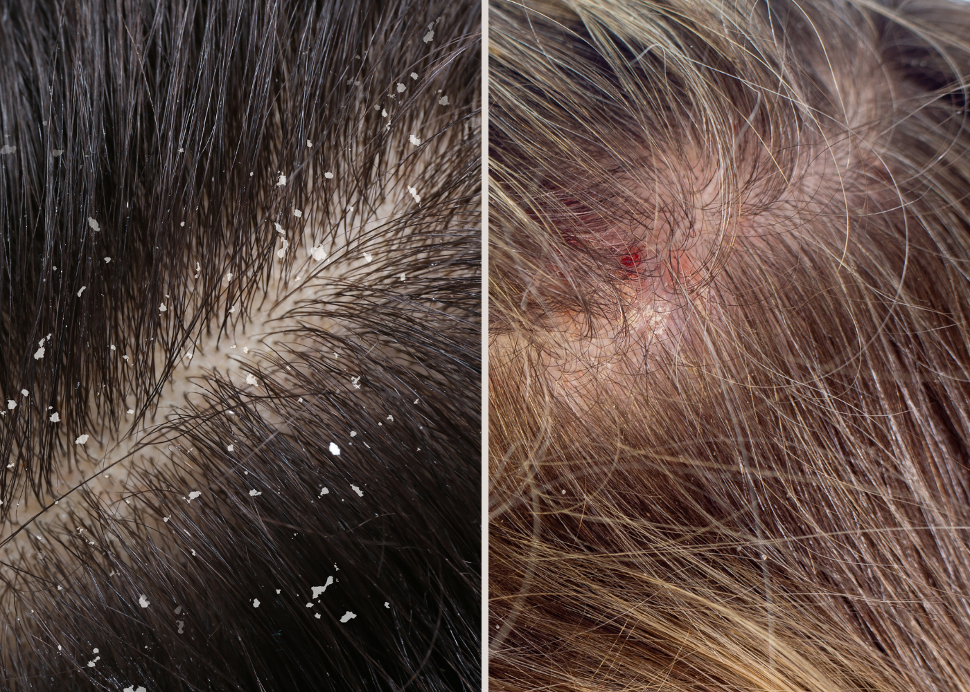 dandruff vs itchy scalp