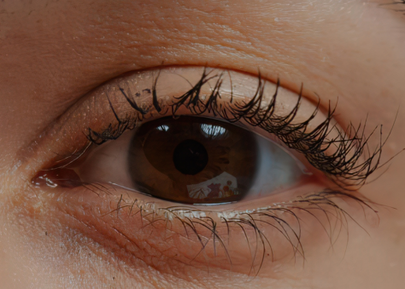blepharitis