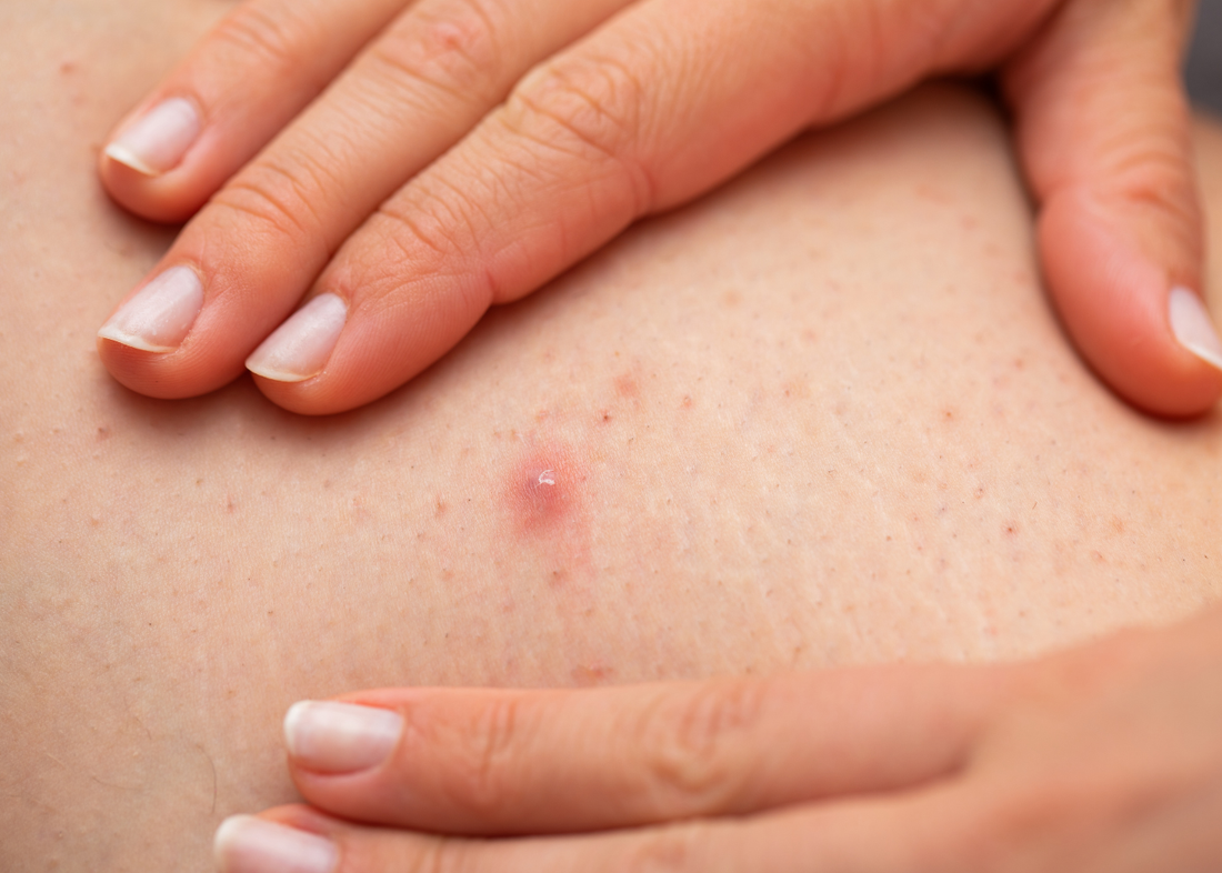 Folliculitis