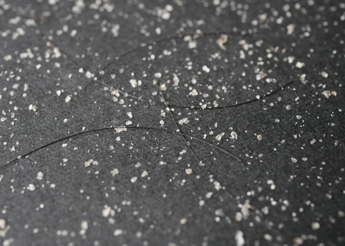 Dandruff and Hair Loss: Can Flakes Really Make Hair Fall Worse?