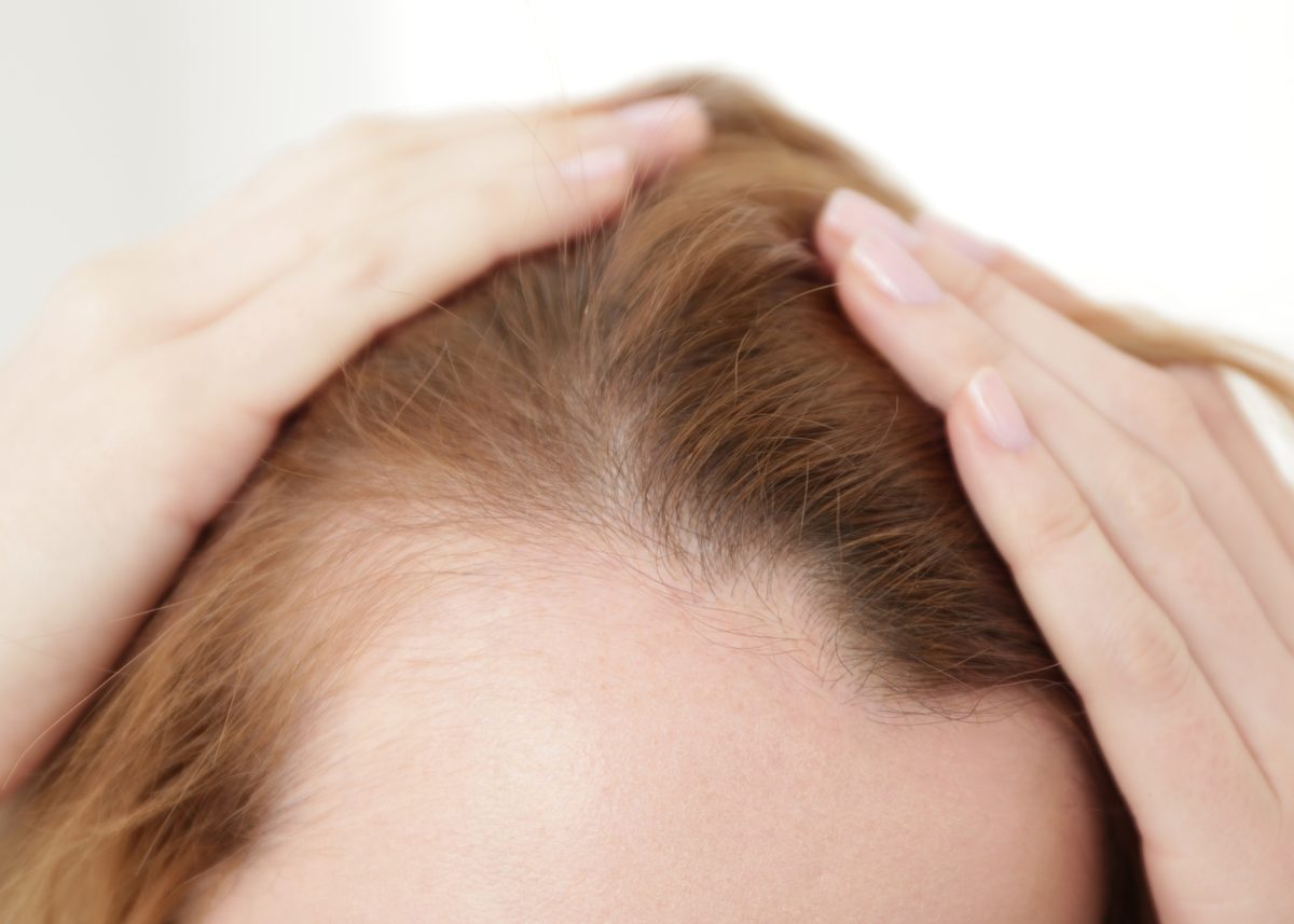 Frontal Fibrosing Alopecia
