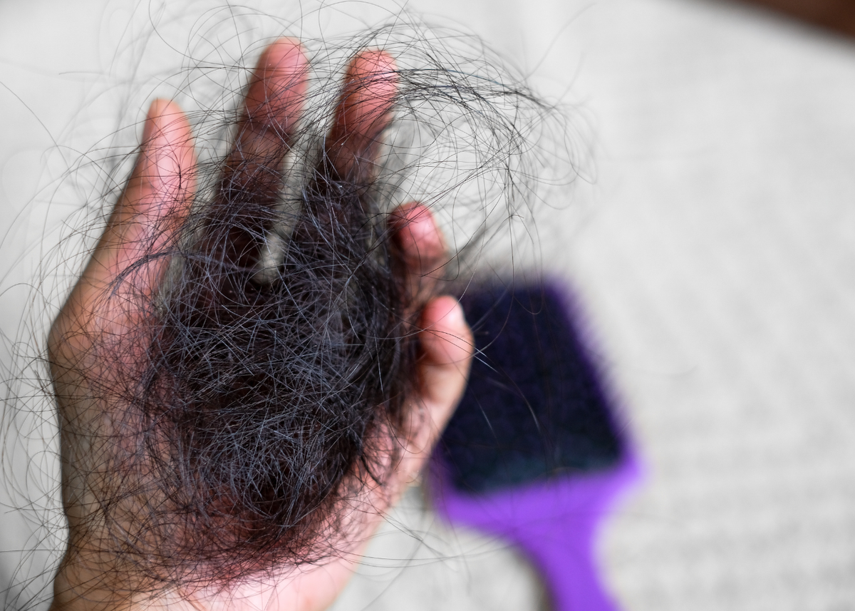 Alopecia Universalis