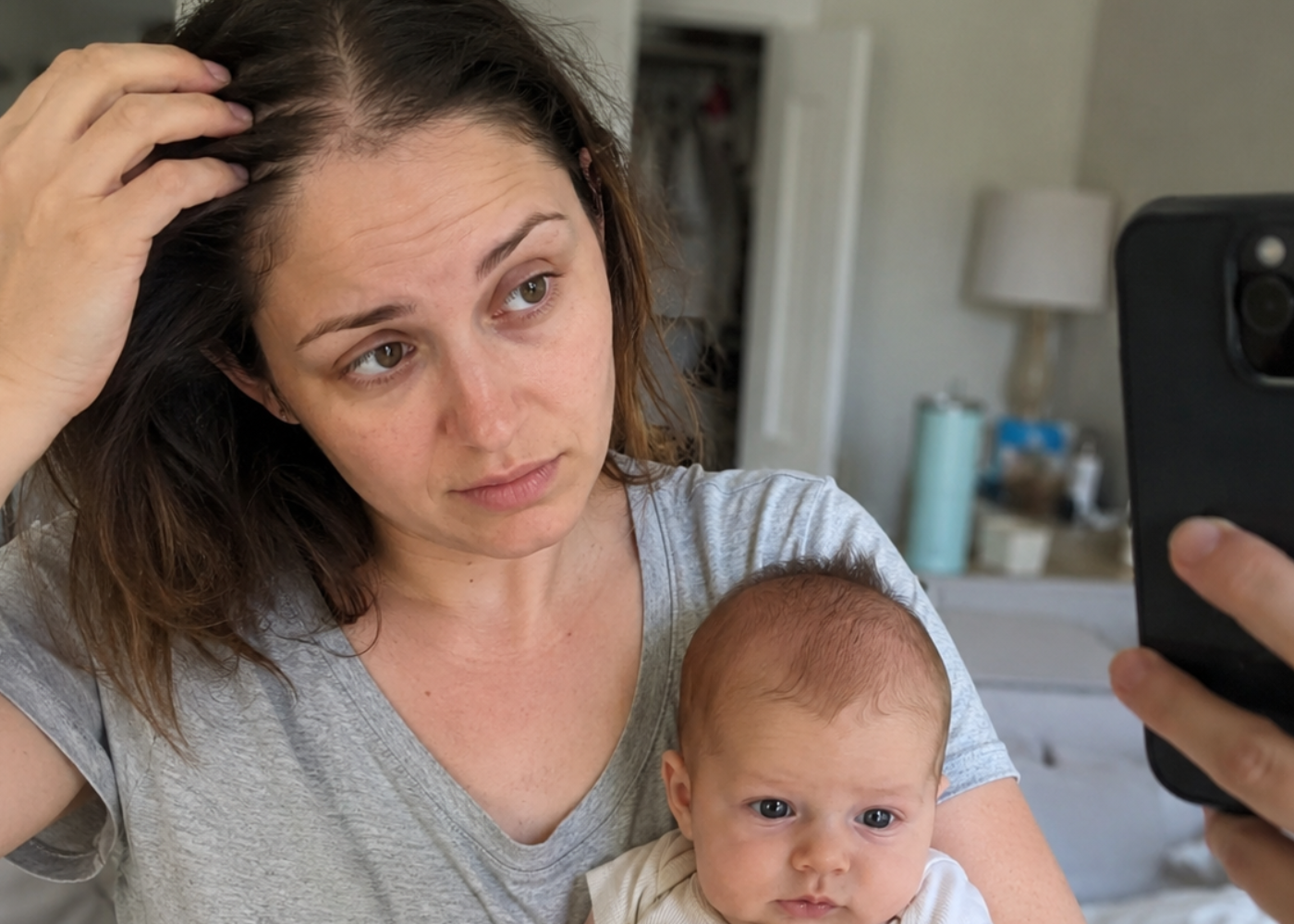 Postpartum Alopecia